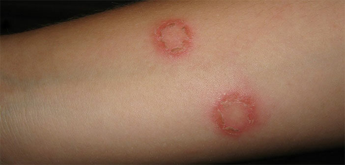 What You Should Know About Ringworm